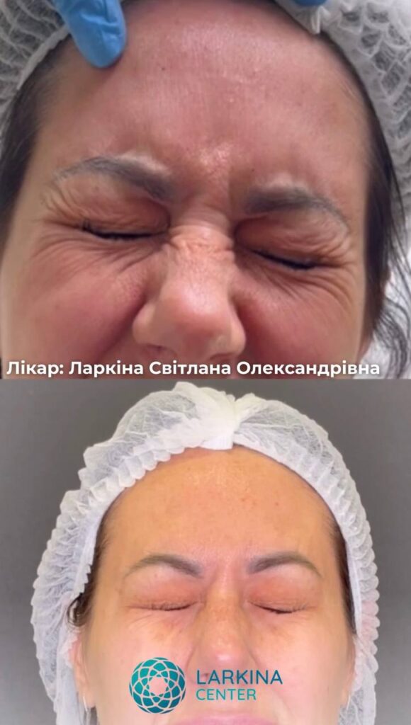 ботокс врач Ларкина Светлана