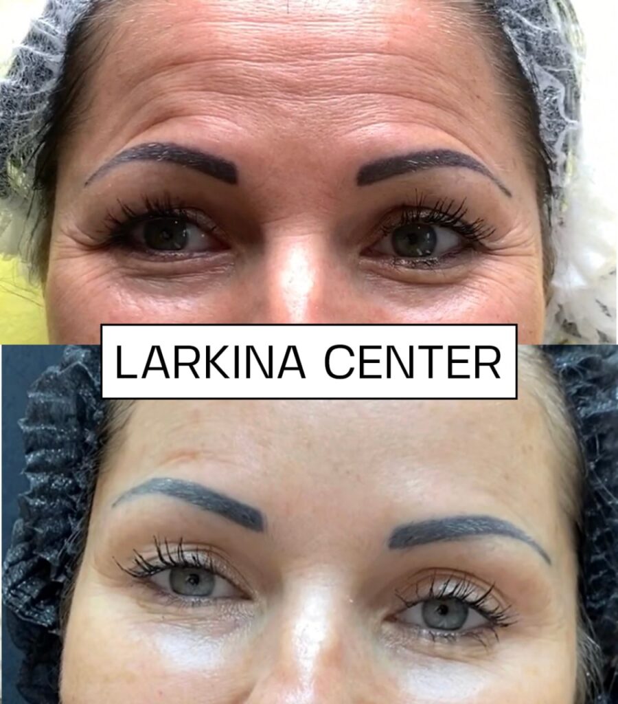 Larkina Center - 5 steps to perfection - the effect of the procedures